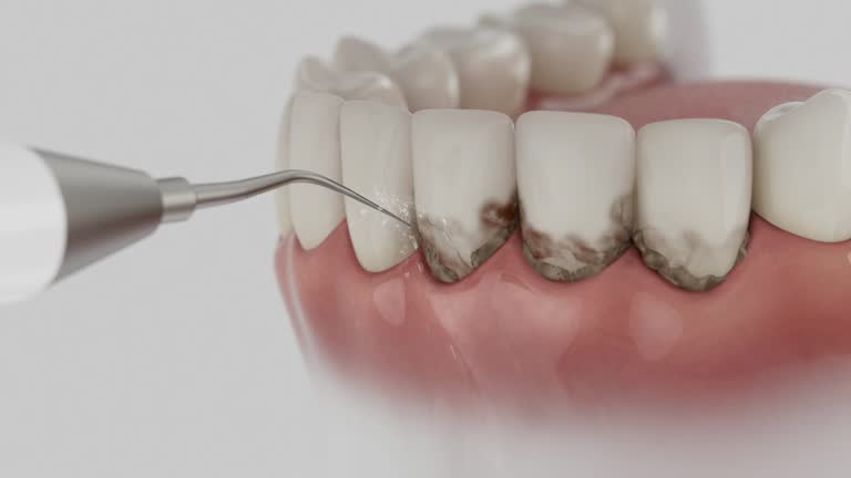Reliable Dental Implants contractor in Abram, TX by Smile Center Dentistry